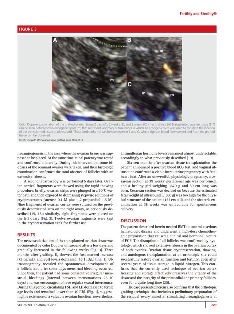 Livebirth after orthotopic transplantation of cryopreserved ovarian ...